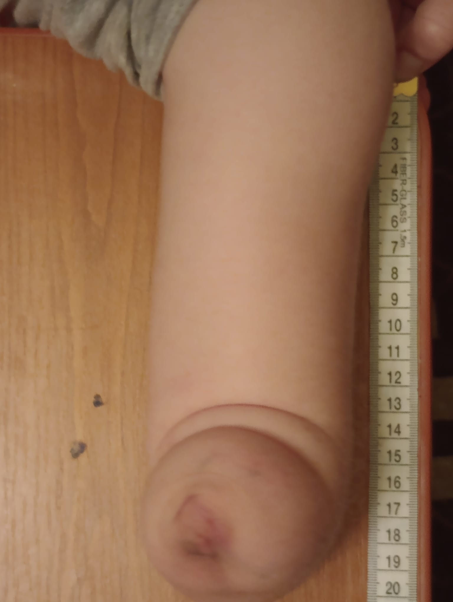 A.'s residual limb measured flat against a ruler, showing length