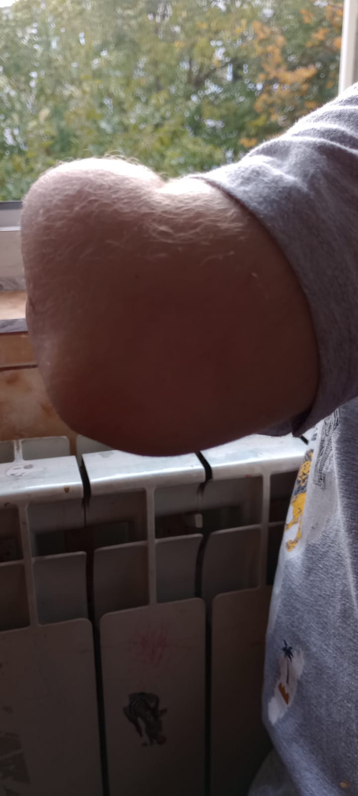 Close-up of A.'s residual limb, tip detail