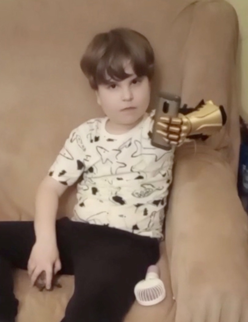 A. wearing the arm, a later photo, white shirt