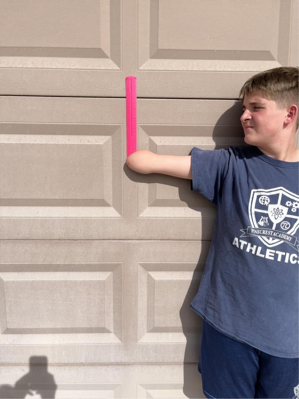Mi. measuring his residual limb against a pink ruler, May 2025