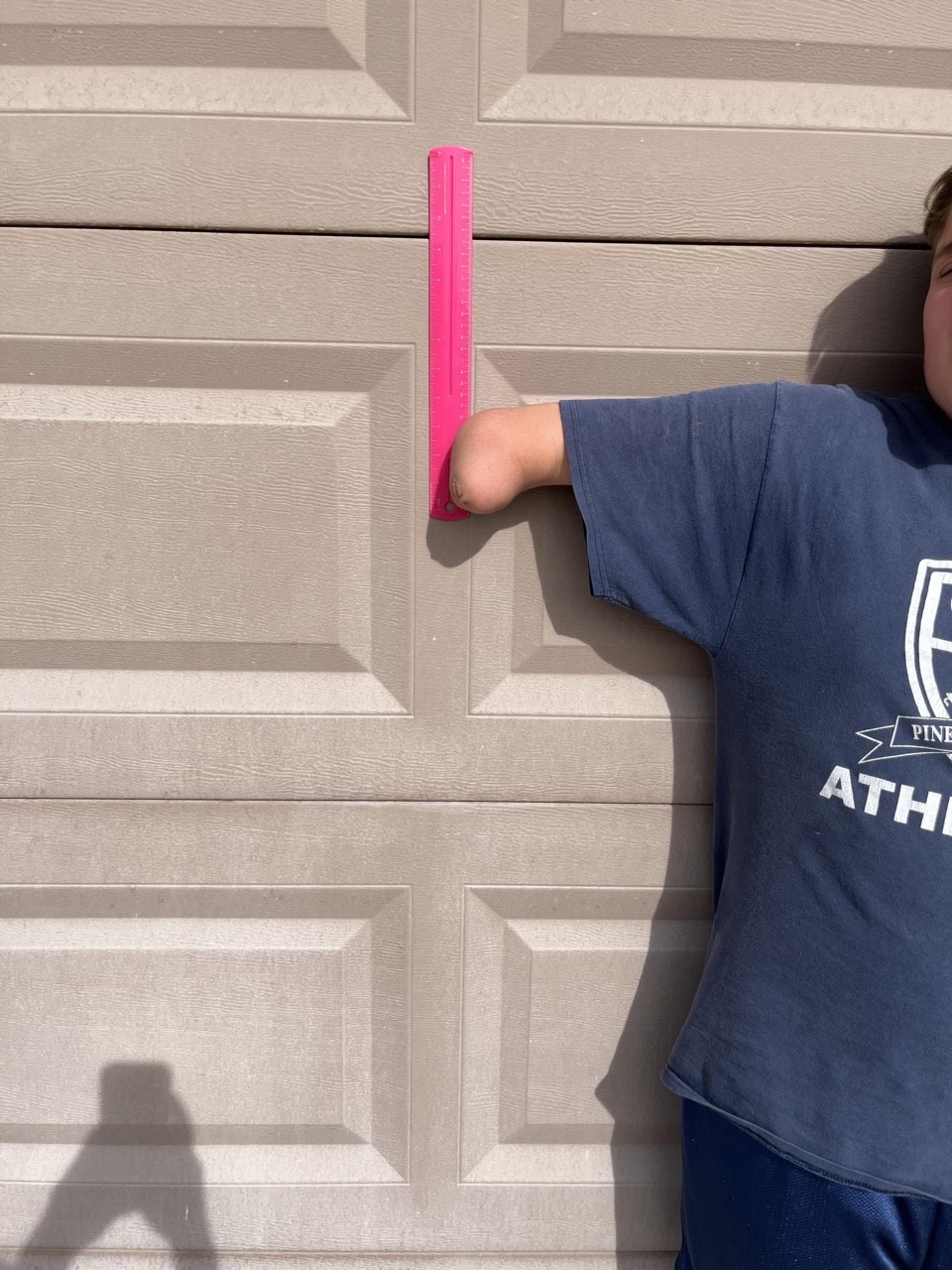 Residual limb against pink ruler, length measurement