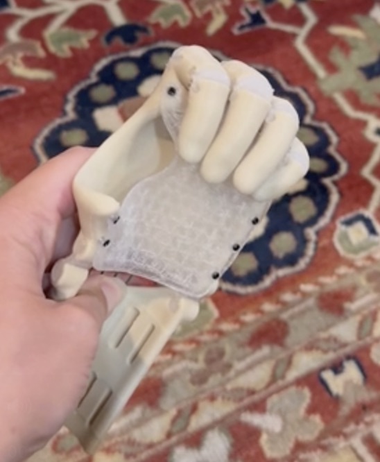 Thumbless hand in gripped position
