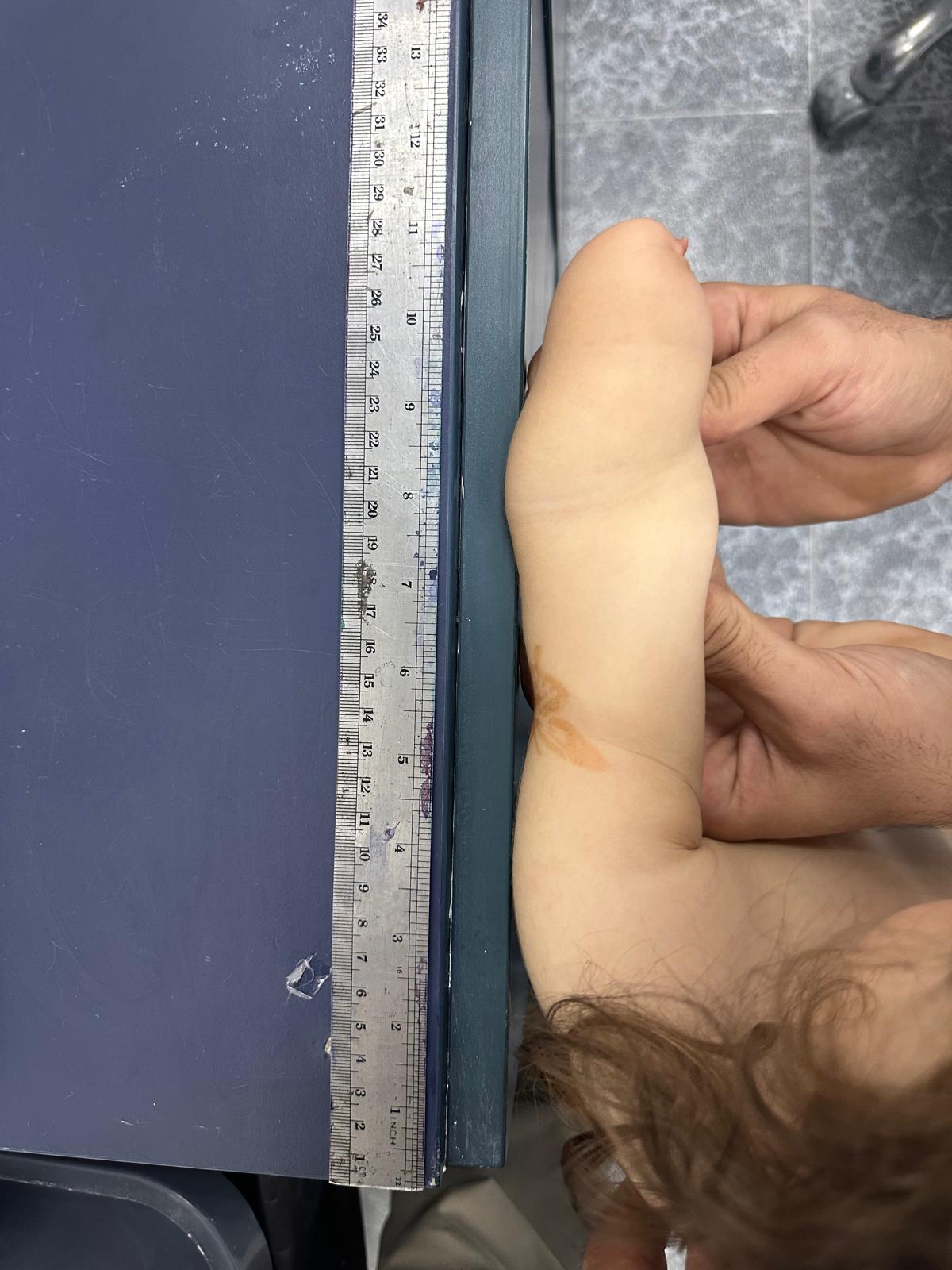 Luai measuring S.'s residual limb length with a ruler at Pal Orthopedics