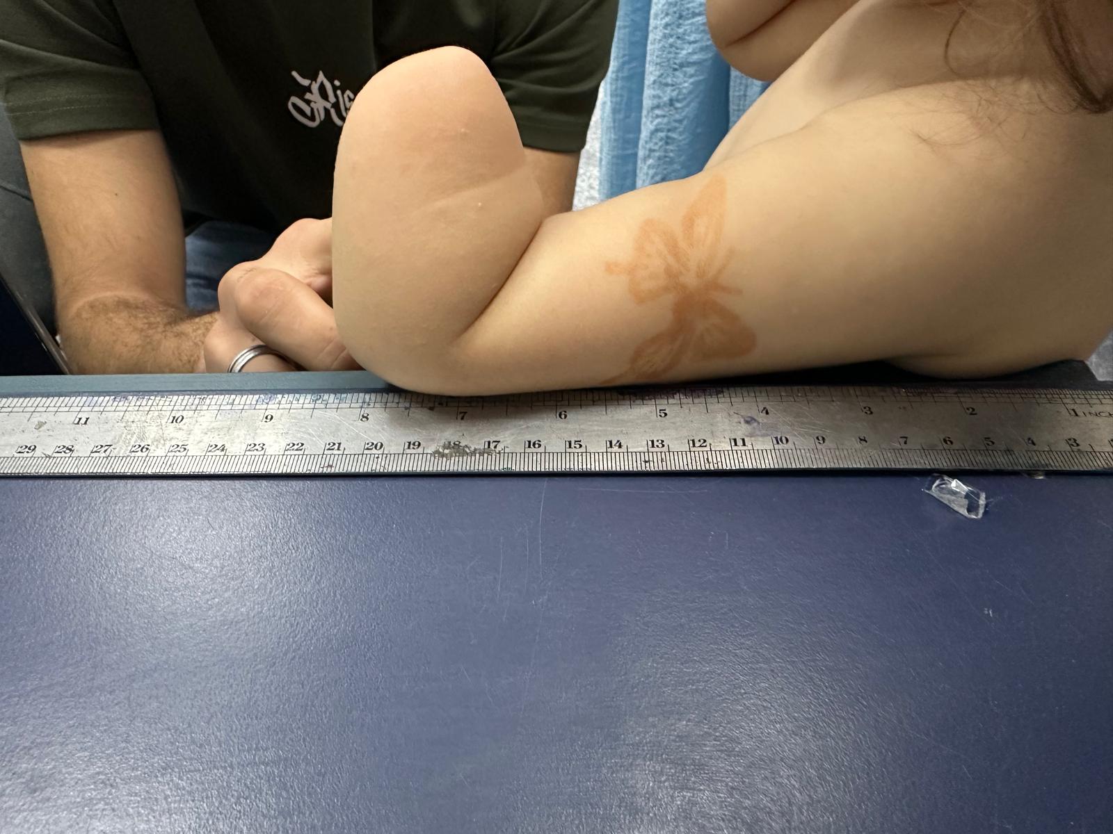 Measurement photo — S.'s arm from a second angle
