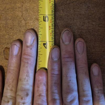 Both of S.P.'s hands side by side with a tape measure, comparing the complete right index finger to the amputated left