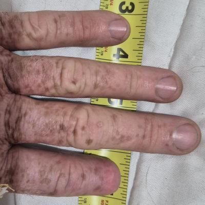 Close-up of S.P.'s left hand with a tape measure laid alongside the fingers