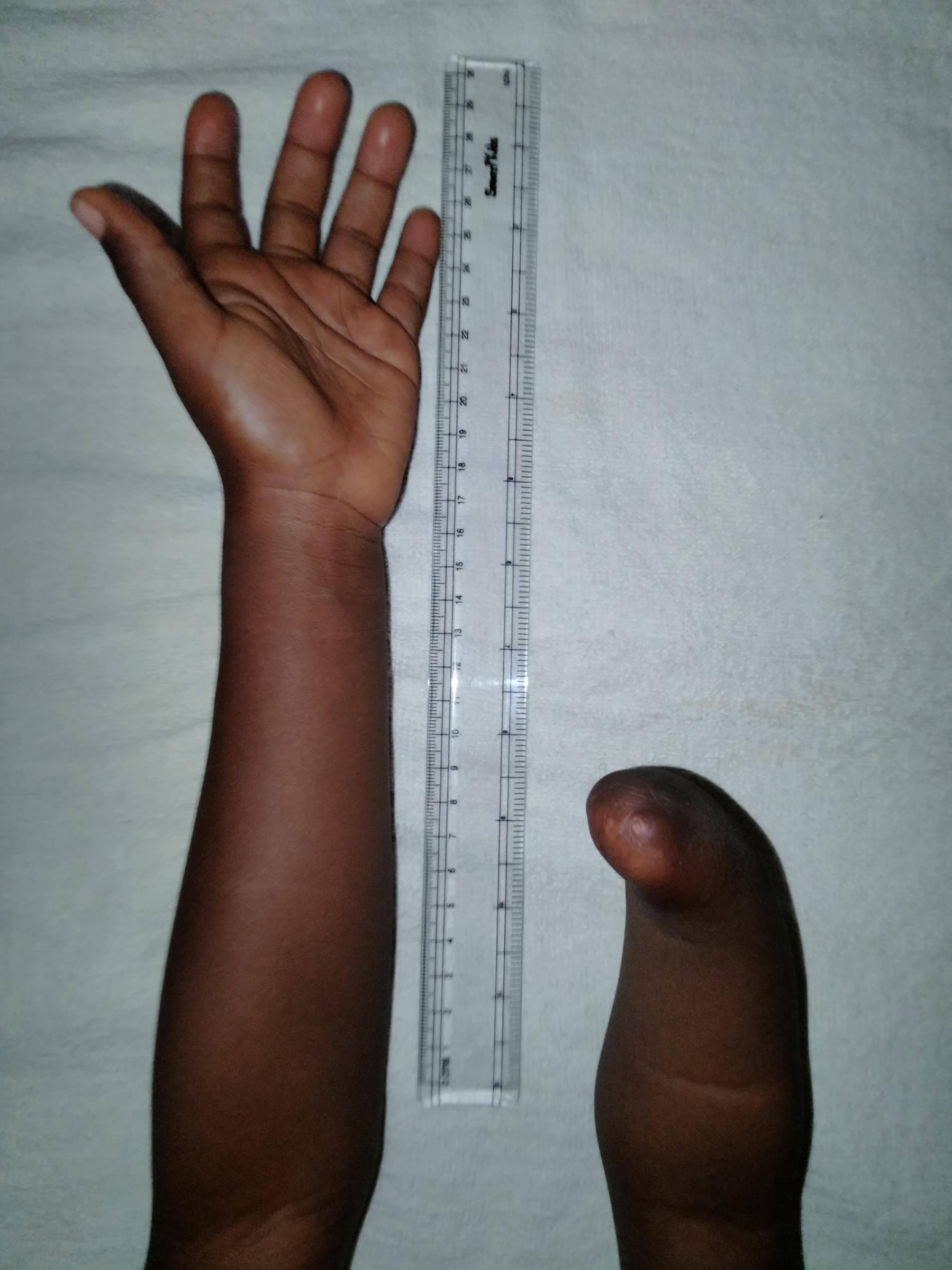 O.'s full arm and residual limb photographed side by side with a ruler, showing the curvature at the tip