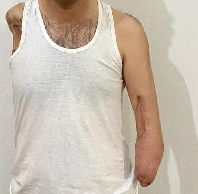 A.'s left stump, front view, showing the below-elbow residual limb