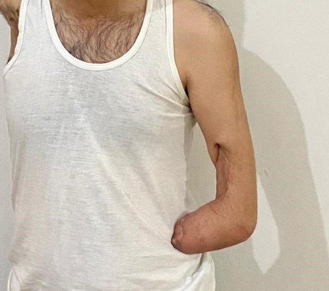 A.'s left stump, side view, arm missing midway between wrist and elbow