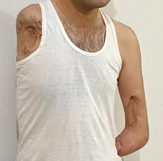 A.'s right side showing the limb difference near the shoulder