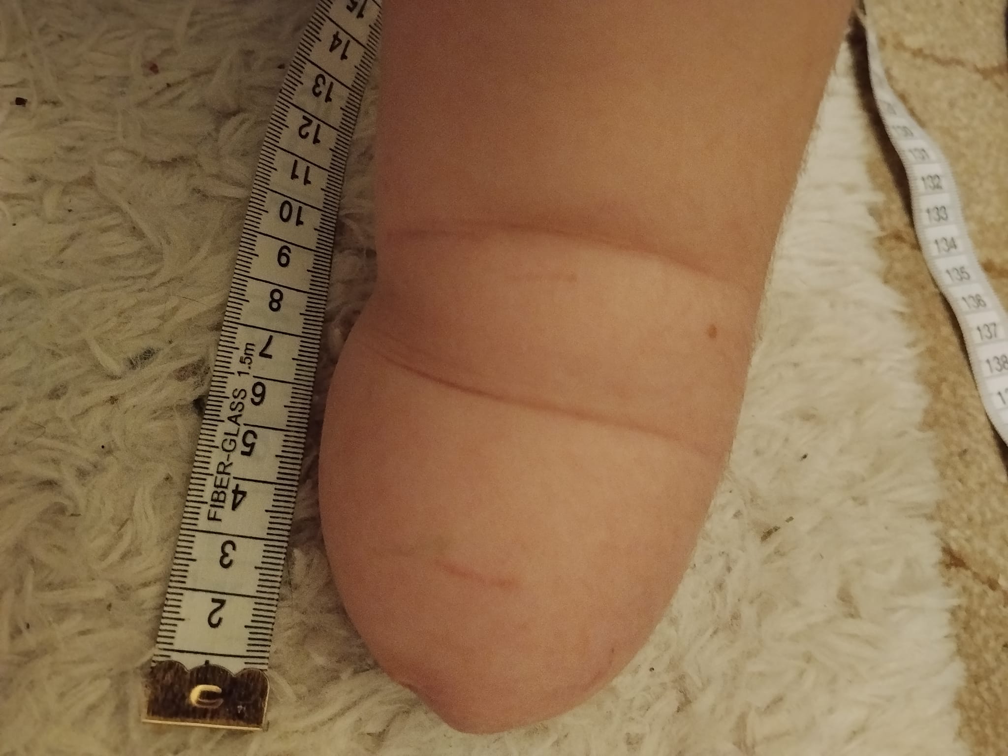 A.'s residual limb photographed from above with a ruler running alongside it, showing the full length